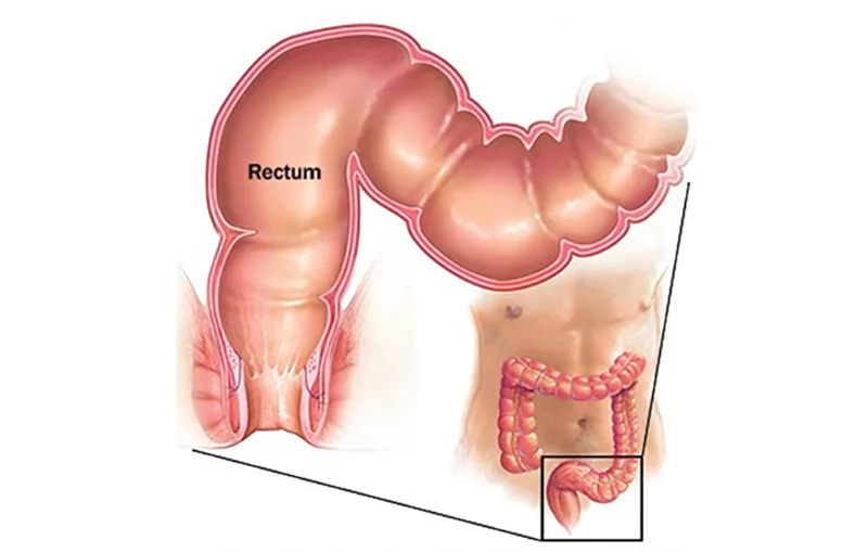Minimally Invasive Surgery