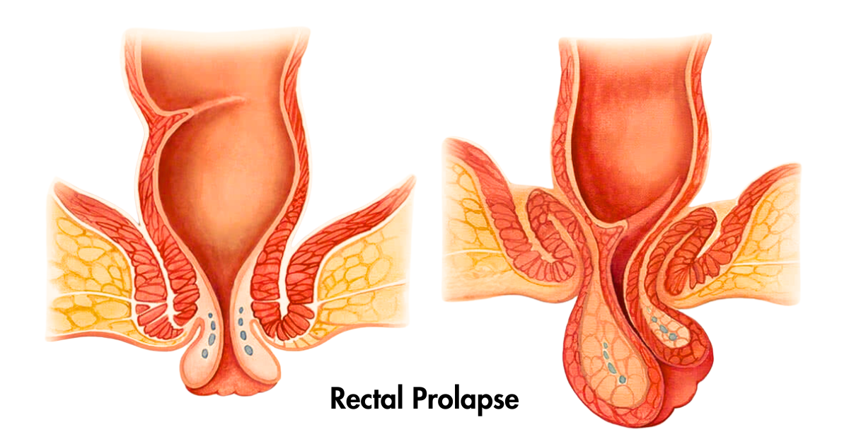 Rectal Prolapse: Symptoms, Causes and Treatment