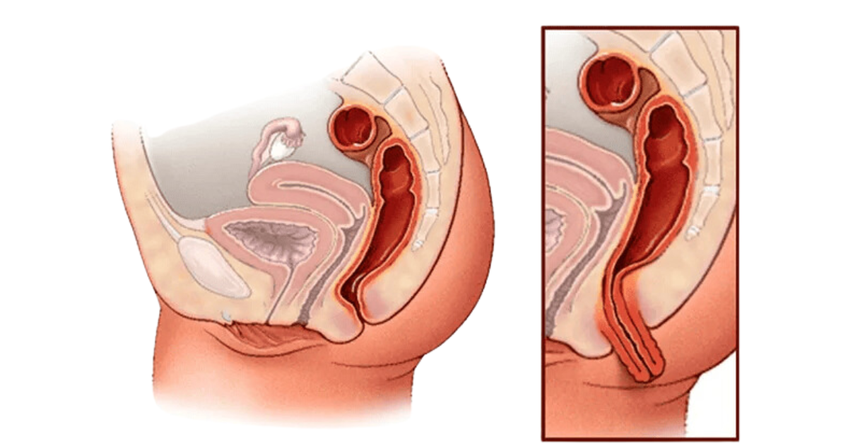 Rectal Prolapse Vs. Hemorrhoids