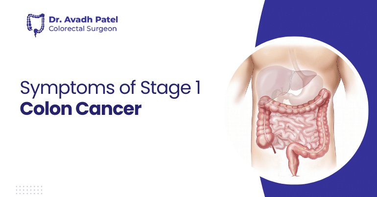 Symptoms of Stage 1 Colon Cancer