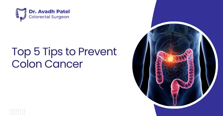 Tips to Prevent Colon Cancer
