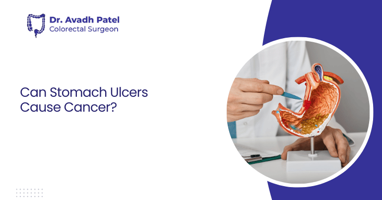 Can Stomach Ulcers Cause Cancer?