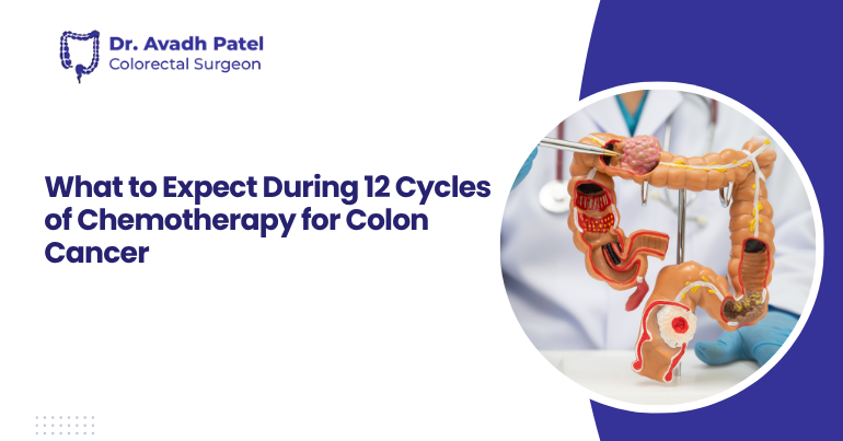 What to Expect During 12 Cycles of Chemotherapy for Colon Cancer