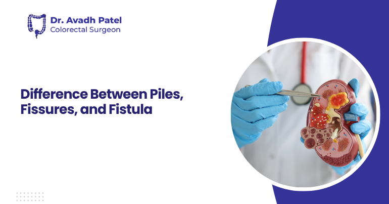 Difference Between Piles, Fissures, and Fistula
