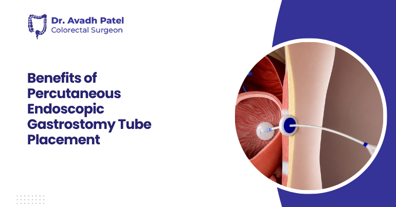 Benefits of Percutaneous Endoscopic Gastrostomy Tube Placement
